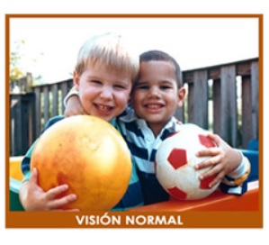 Distrofias de retina: Un implante frena la pérdida visual por degeneración macular