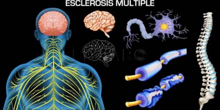 ¿Cómo puede progresar la Esclerosis Múltiple?