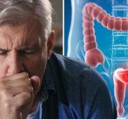 La prevención es clave ante el aumento de casos de cáncer de colon